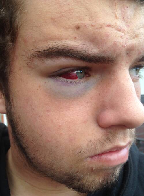 BRUISED: Prospect's Caleb Bushing shows the effects of the injuries to his face.