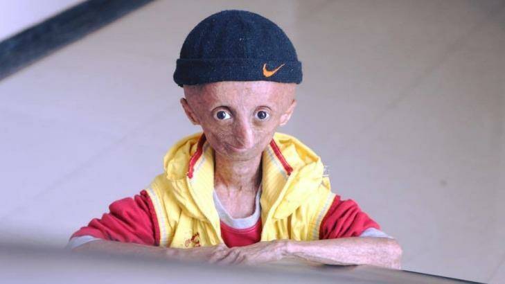 Nihal Bitla, who has died aged 15, suffered from progeria, which causes accelerated ageing.   Photo: Facebook Team Nihal