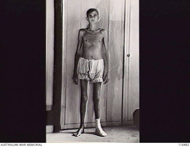 Singapore, September 9, 1945. Private A. Kirkham of the 2/40th Battalion. Ex-prisoner of war and now a patient at the 2/14th Australian General Hospital. He was taken prisoners on February 23, 1942 and dropped from 11 stone, seven pound to eight stone in weight. Picture: Australian War Memorial/116482