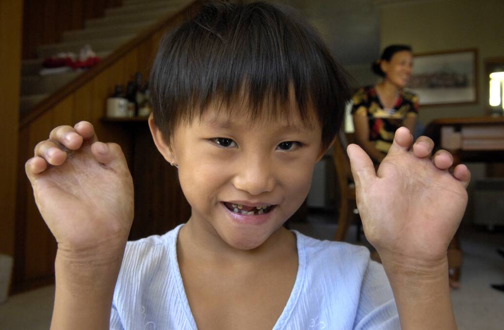 17/01/2008 Nguyen Thi Kieu 6y of Vietnam, underwent surgery on her hands at St Vincents Hospital. Picture: Paul Scambler