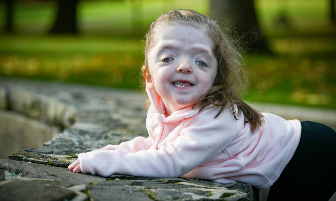 Launceston's Isla Wells was born with apert syndrome, a genetic disorder that causes webbed hands and feet and the early fusion of the skull. Pictures: Paul Scambler 