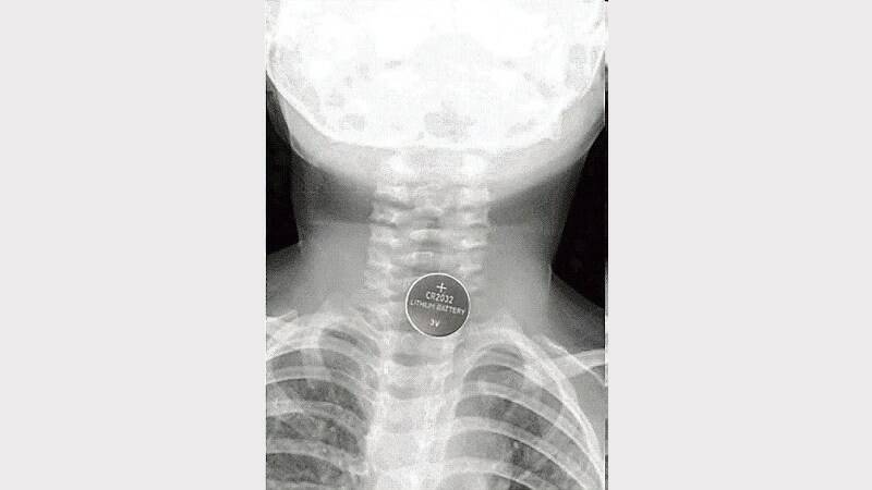 An X-ray of a Queensland toddler who swallowed a battery that ended up lodged in his oesophagus.